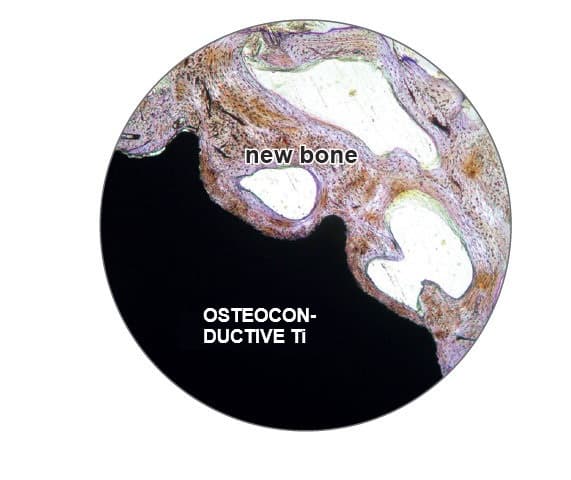 Histological view showing new bone adjacent to an osteoconductive titanium implant surface.